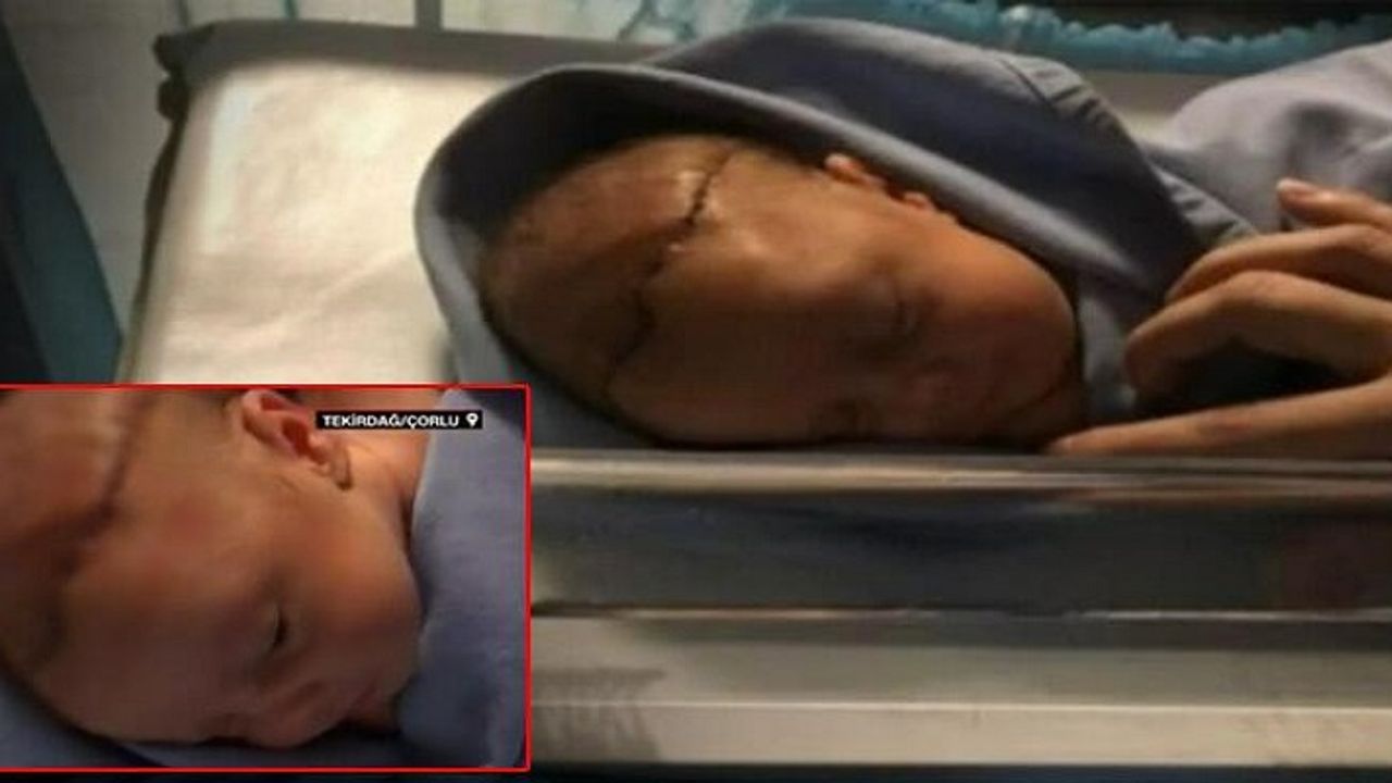 Tekirdağ'da Doğum Esnasında Dehşet! Doktor Bebeğin Başını Neşterle Kesti