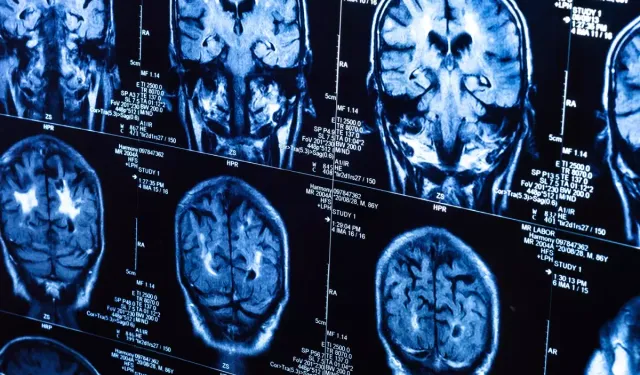 Covid-19 Beyin Yaşlanmasını Hızlandırdı