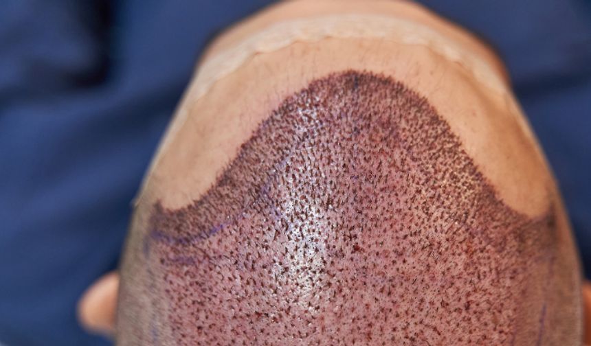 Trabzon’da Saç Ekimi Sırasında Fenalaşan Temel Altuntaş Hayatını Kaybetti